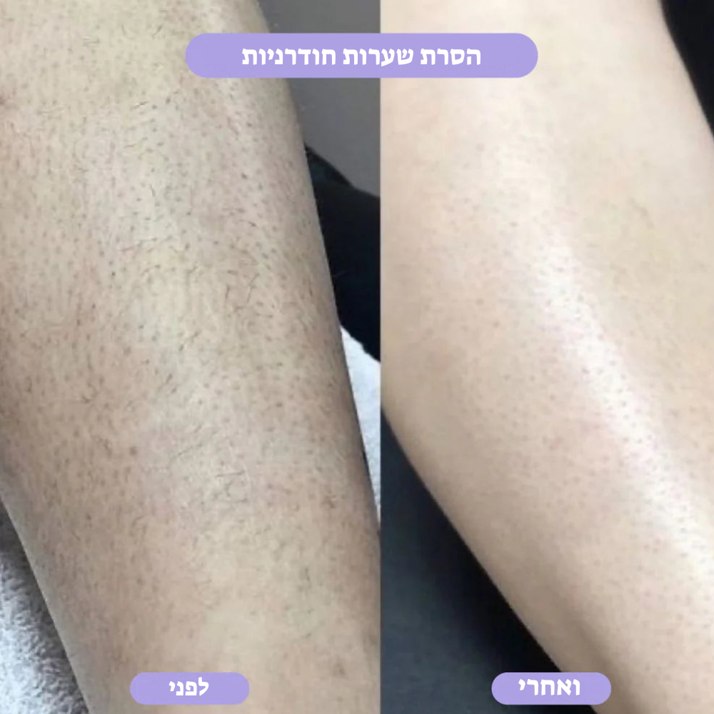 מחק שיער קריסטל – הסרת שיער טבעית, ללא כאבים LAVIN VUITTON