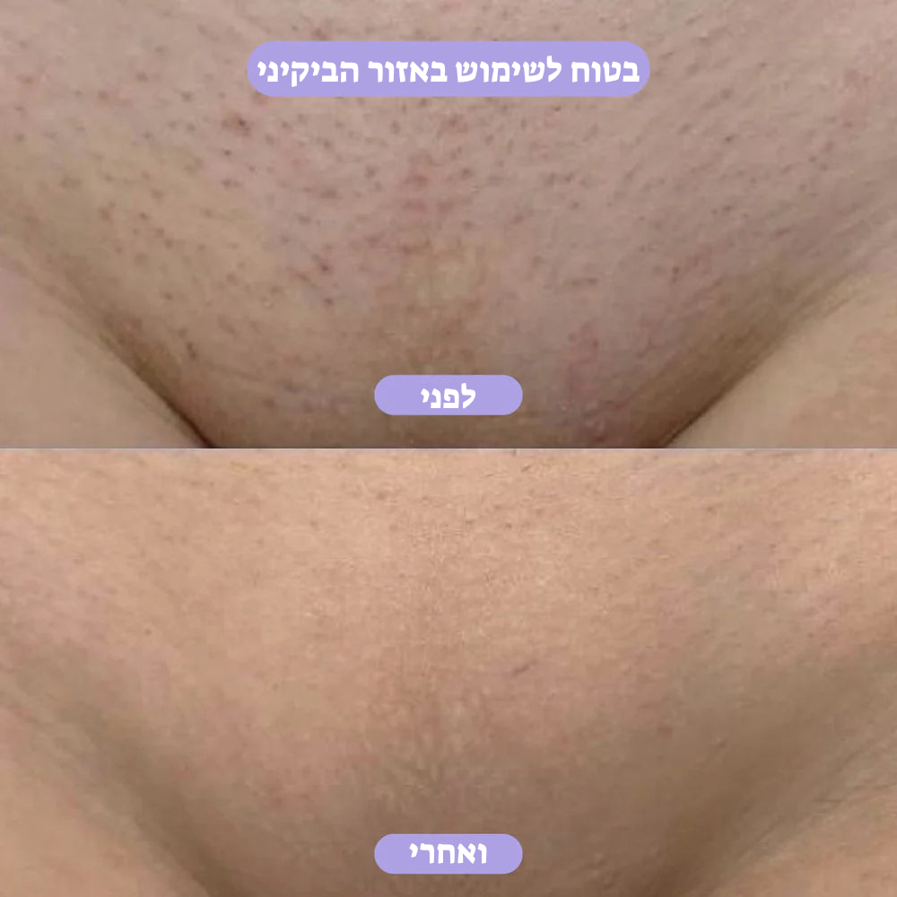 מחק שיער קריסטל – הסרת שיער טבעית, ללא כאבים LAVIN VUITTON
